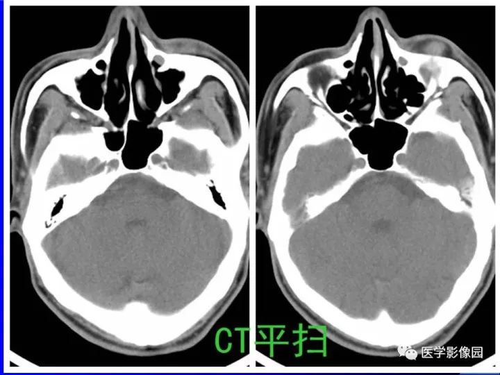 【病例】左眼黑色素瘤1例CT及MR影像表现