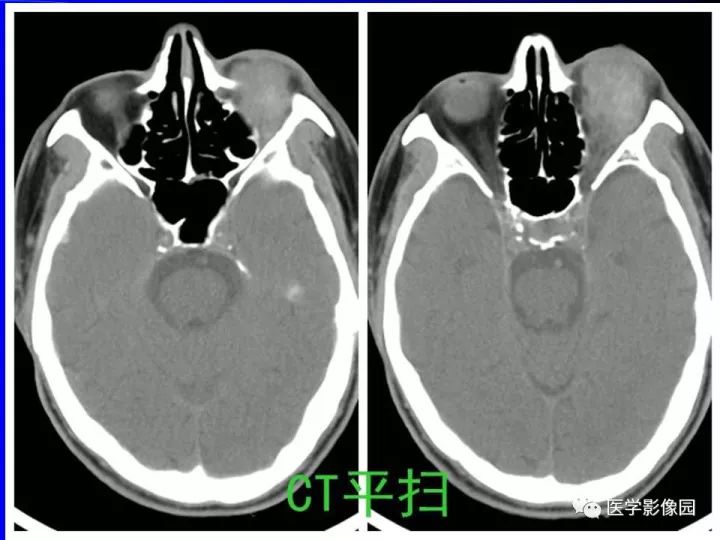 【病例】左眼黑色素瘤1例CT及MR影像表现
