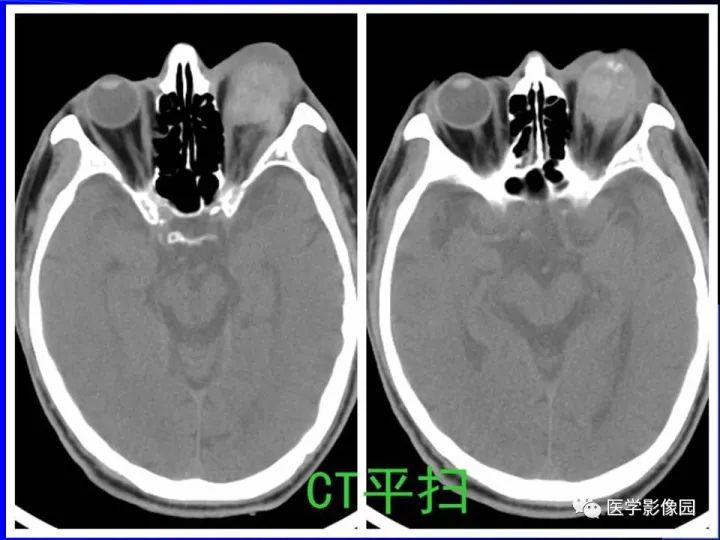 【病例】左眼黑色素瘤1例CT及MR影像表现