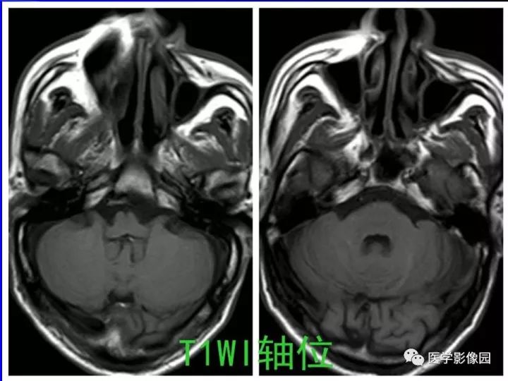 【病例】左眼黑色素瘤1例CT及MR影像表现