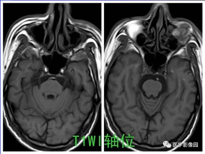 【病例】左眼黑色素瘤1例CT及MR影像表现