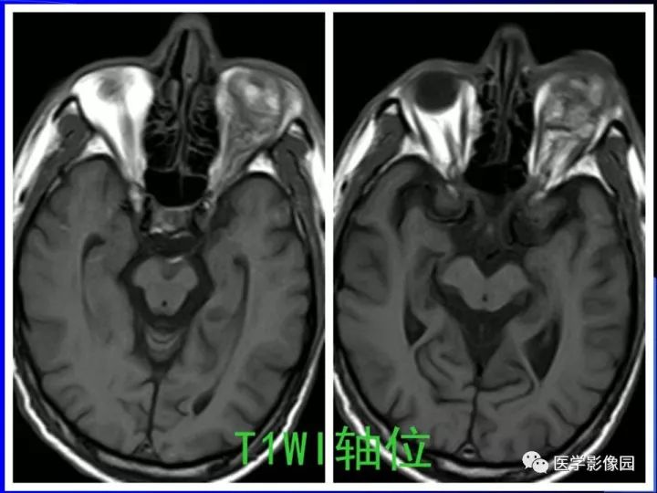 【病例】左眼黑色素瘤1例CT及MR影像表现