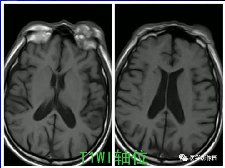 【病例】左眼黑色素瘤1例CT及MR影像表现