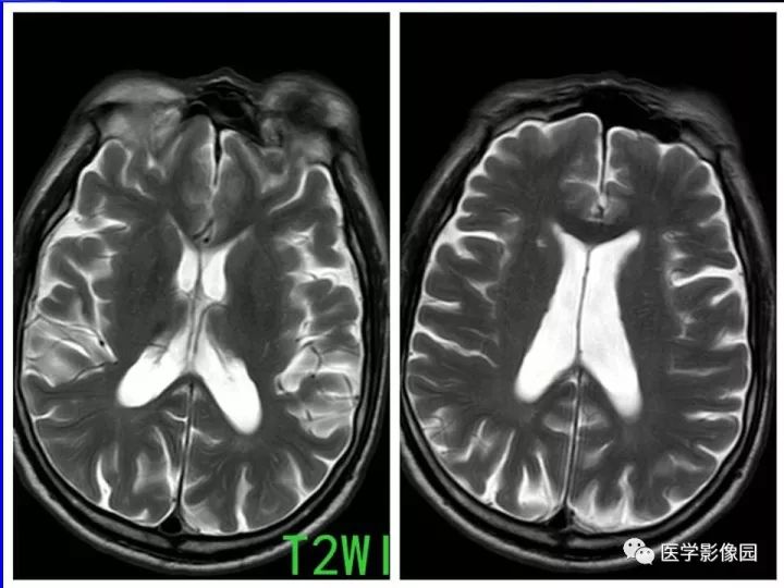 【病例】左眼黑色素瘤1例CT及MR影像表现