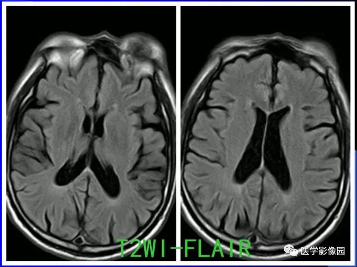 【病例】左眼黑色素瘤1例CT及MR影像表现