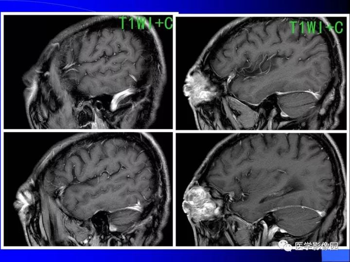 【病例】左眼黑色素瘤1例CT及MR影像表现