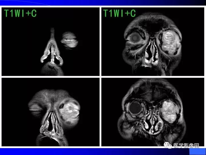 【病例】左眼黑色素瘤1例CT及MR影像表现