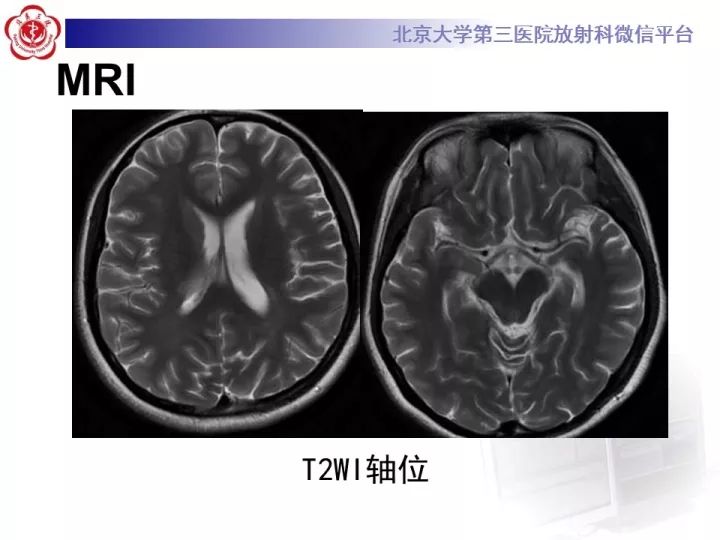 【病例】急性播散型脑脊髓炎1例MR影像诊断