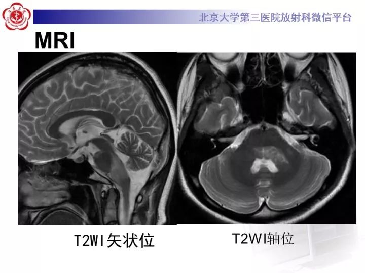 【病例】急性播散型脑脊髓炎1例MR影像诊断