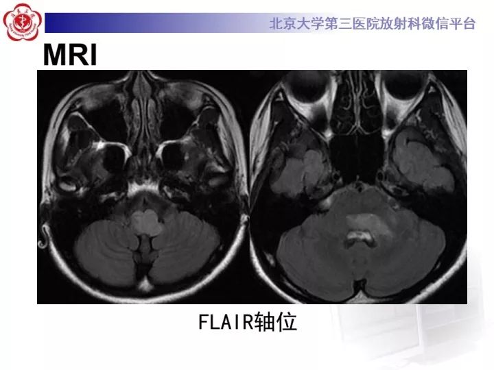【病例】急性播散型脑脊髓炎1例MR影像诊断