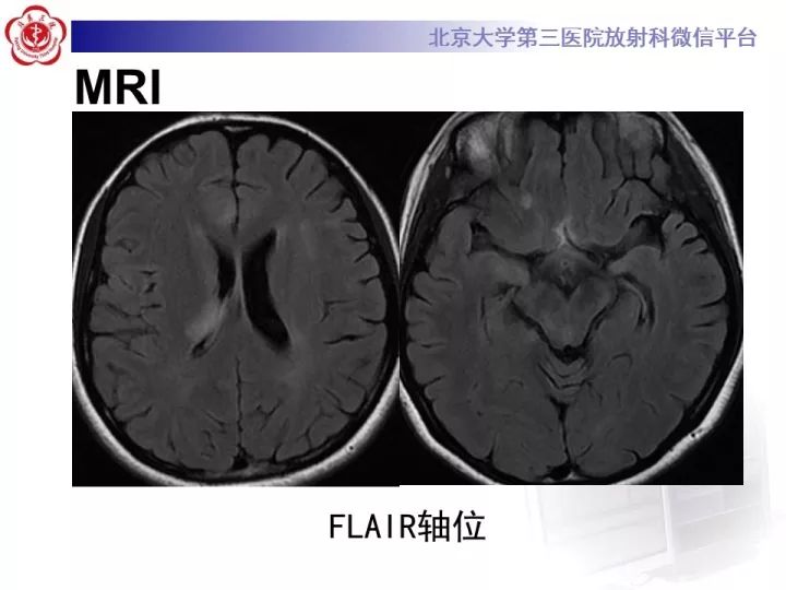 【病例】急性播散型脑脊髓炎1例MR影像诊断