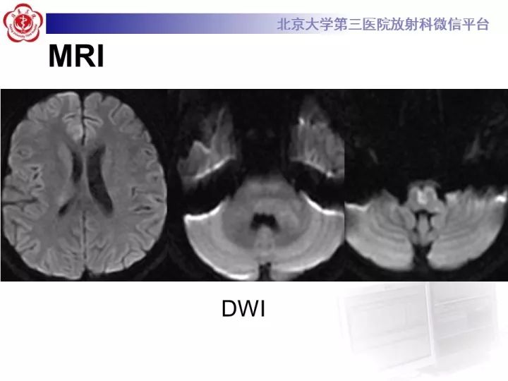 【病例】急性播散型脑脊髓炎1例MR影像诊断