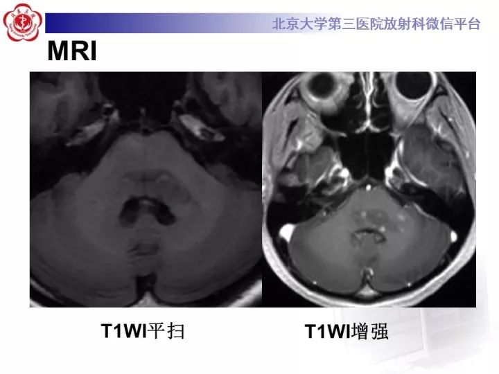 【病例】急性播散型脑脊髓炎1例MR影像诊断