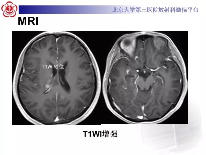 【病例】急性播散型脑脊髓炎1例MR影像诊断
