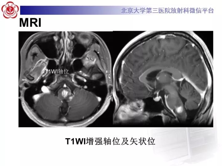 【病例】急性播散型脑脊髓炎1例MR影像诊断