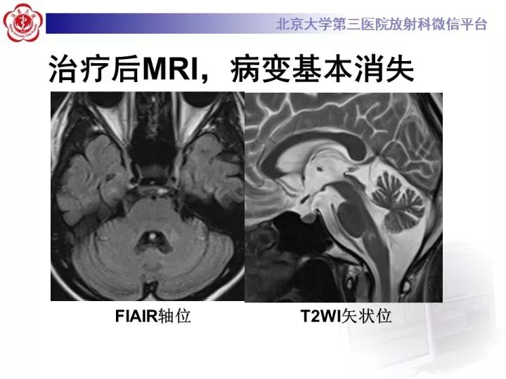 【病例】急性播散型脑脊髓炎1例MR影像诊断
