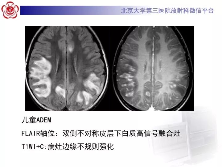 【病例】急性播散型脑脊髓炎1例MR影像诊断