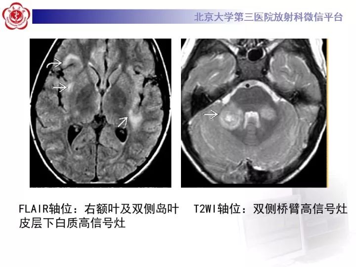 【病例】急性播散型脑脊髓炎1例MR影像诊断