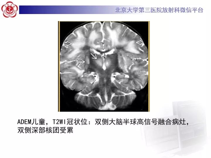 【病例】急性播散型脑脊髓炎1例MR影像诊断