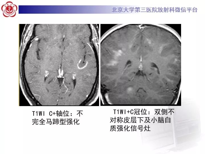 【病例】急性播散型脑脊髓炎1例MR影像诊断