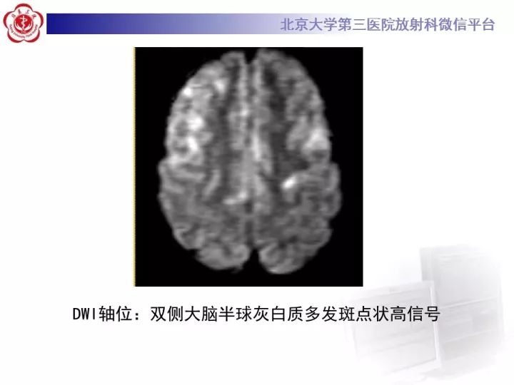 【病例】急性播散型脑脊髓炎1例MR影像诊断