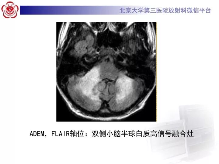 【病例】急性播散型脑脊髓炎1例MR影像诊断