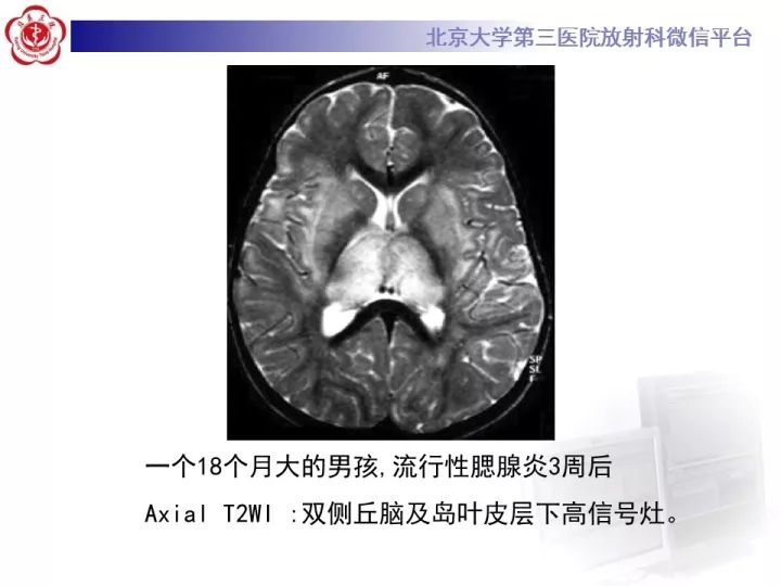 【病例】急性播散型脑脊髓炎1例MR影像诊断