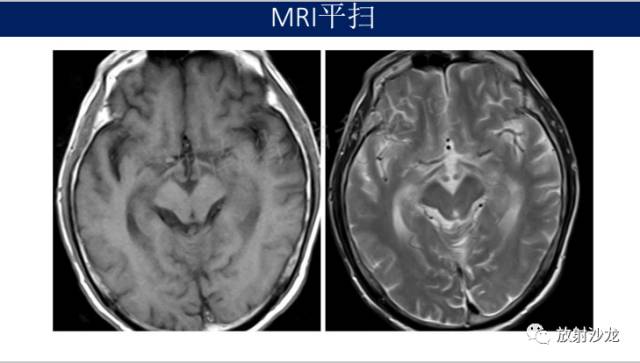 【病例】中枢神经系统淋巴瘤1例CT及MR