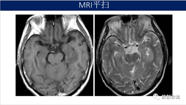 【病例】中枢神经系统淋巴瘤1例CT及MR