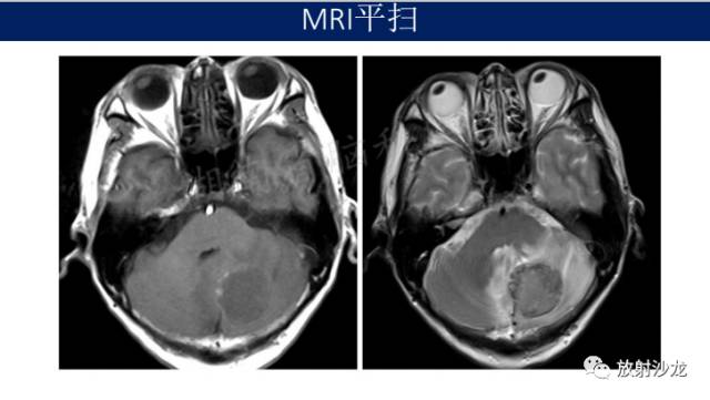 【病例】中枢神经系统淋巴瘤1例CT及MR