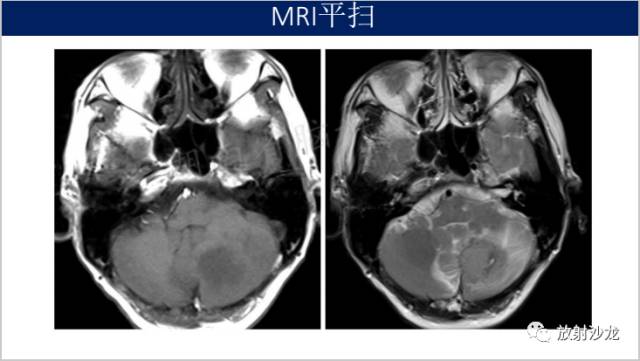 【病例】中枢神经系统淋巴瘤1例CT及MR