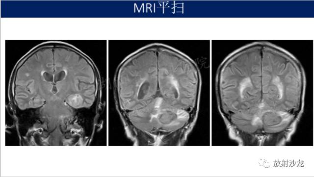 【病例】中枢神经系统淋巴瘤1例CT及MR