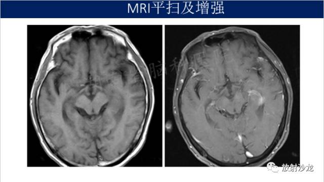 【病例】中枢神经系统淋巴瘤1例CT及MR