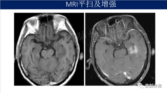 【病例】中枢神经系统淋巴瘤1例CT及MR