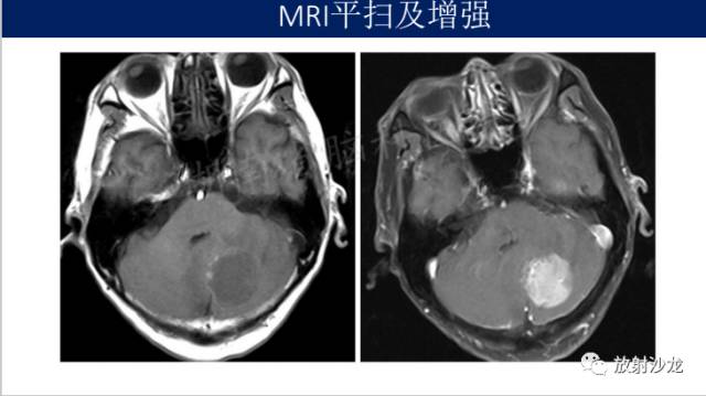 【病例】中枢神经系统淋巴瘤1例CT及MR
