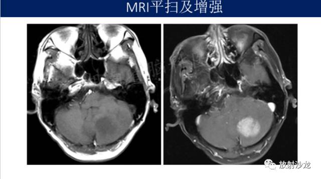 【病例】中枢神经系统淋巴瘤1例CT及MR