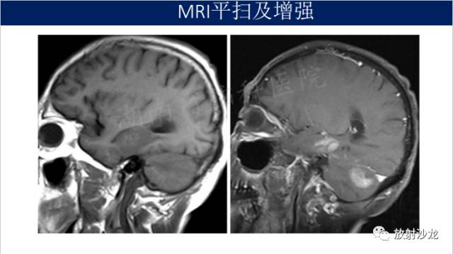 【病例】中枢神经系统淋巴瘤1例CT及MR