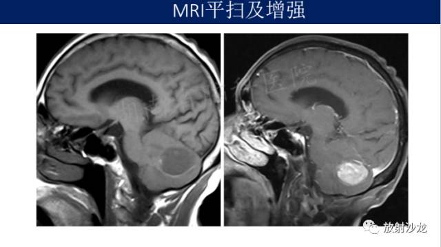 【病例】中枢神经系统淋巴瘤1例CT及MR