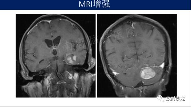 【病例】中枢神经系统淋巴瘤1例CT及MR