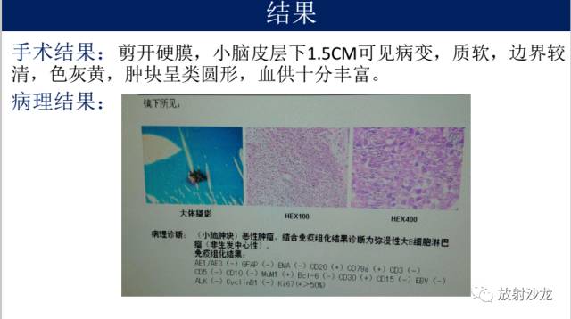 【病例】中枢神经系统淋巴瘤1例CT及MR