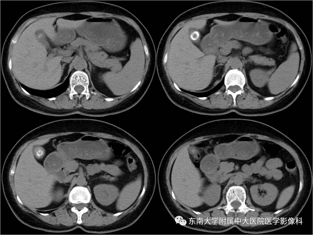 【病例】胆囊腺肌症1例CT及MR影像表现