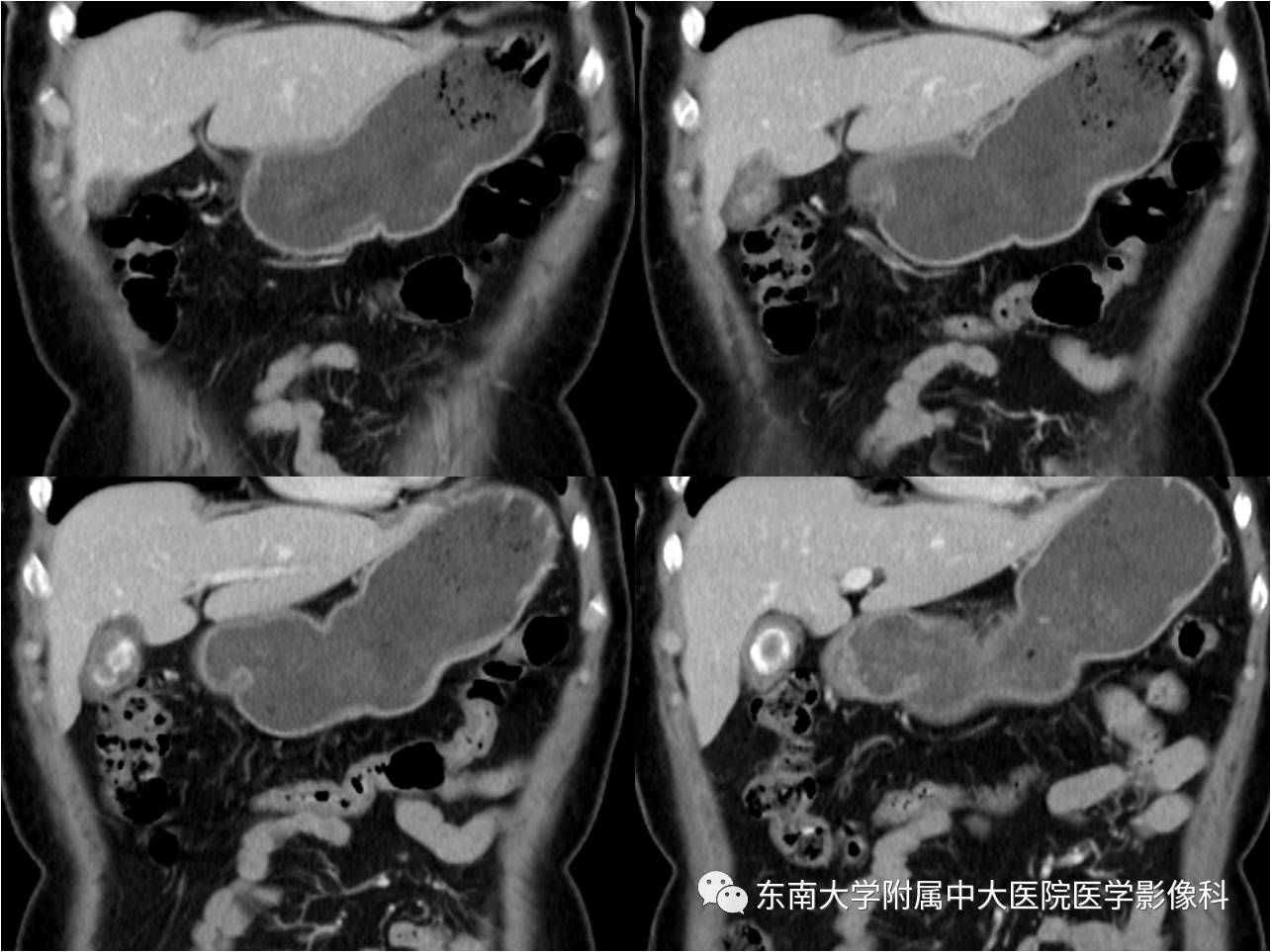 【病例】胆囊腺肌症1例CT及MR影像表现