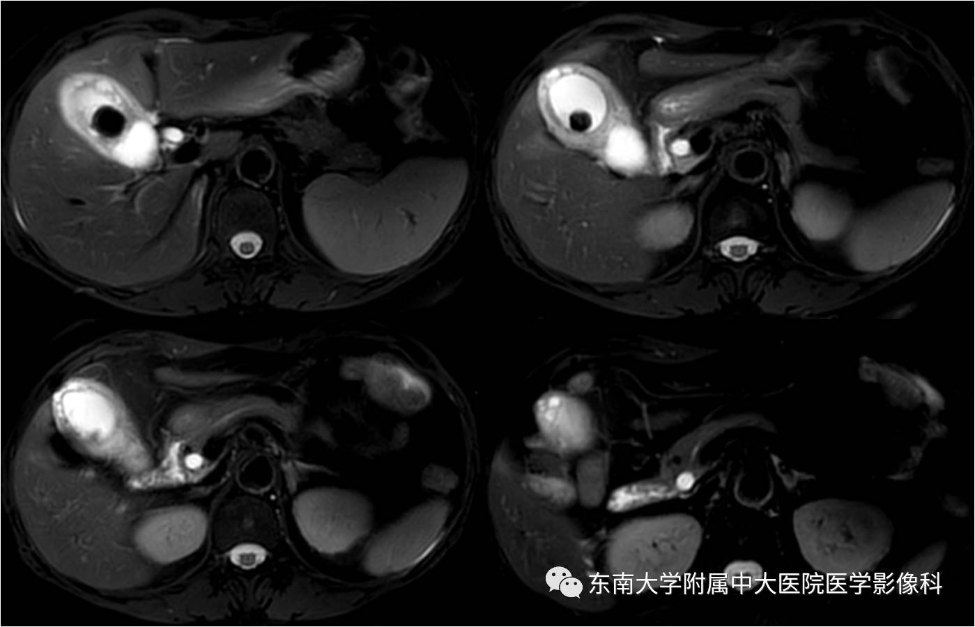 【病例】胆囊腺肌症1例CT及MR影像表现