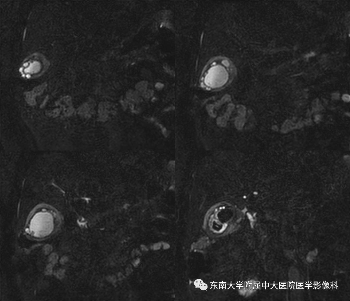 【病例】胆囊腺肌症1例CT及MR影像表现