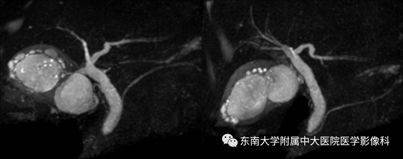【病例】胆囊腺肌症1例CT及MR影像表现