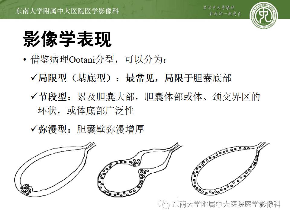【病例】胆囊腺肌症1例CT及MR影像表现