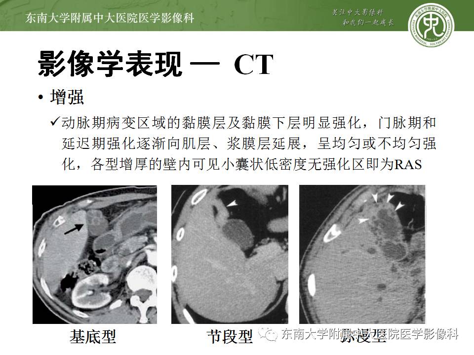 【病例】胆囊腺肌症1例CT及MR影像表现