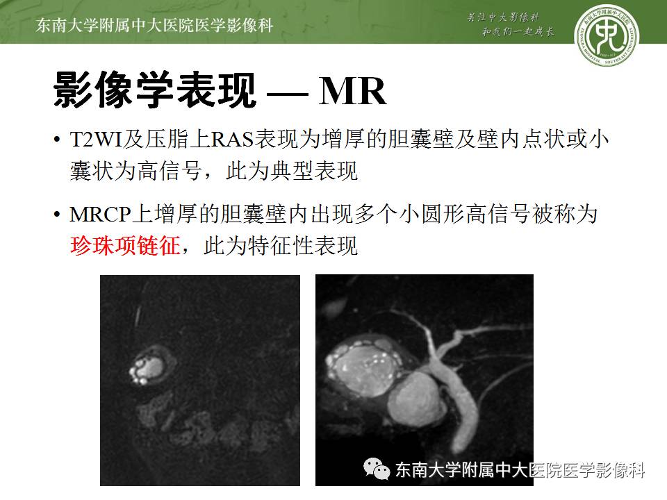【病例】胆囊腺肌症1例CT及MR影像表现