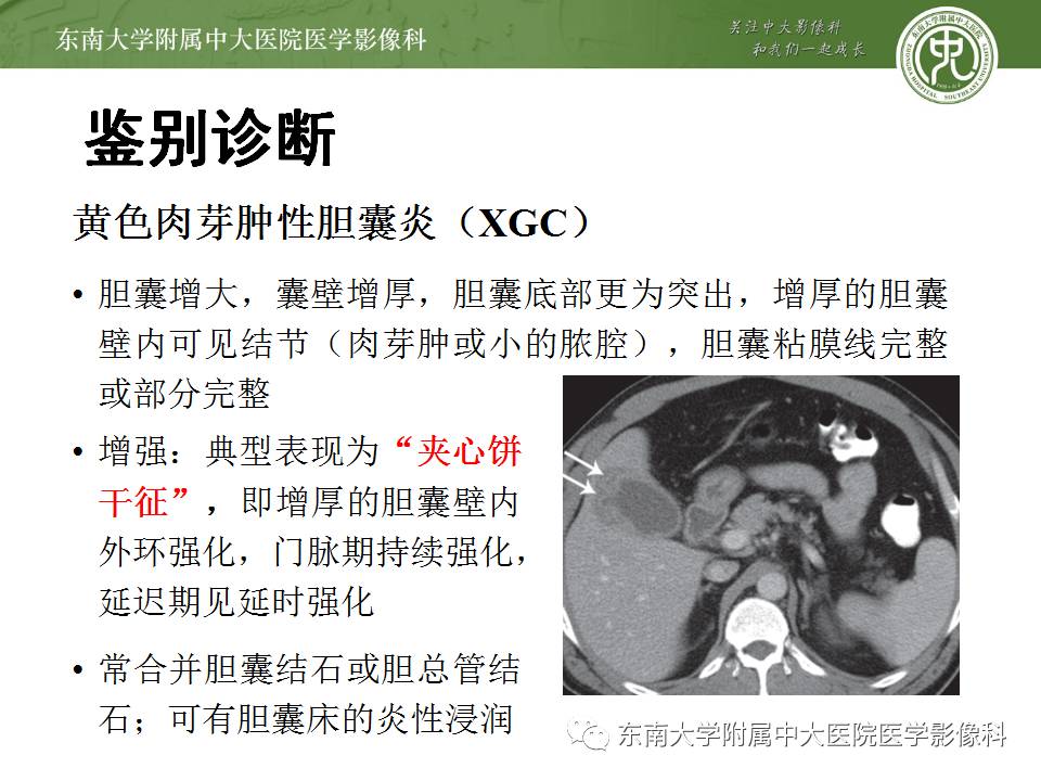 【病例】胆囊腺肌症1例CT及MR影像表现