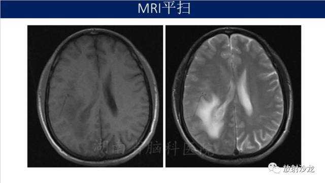 【病例】胶质母细胞瘤1例MR影像表现